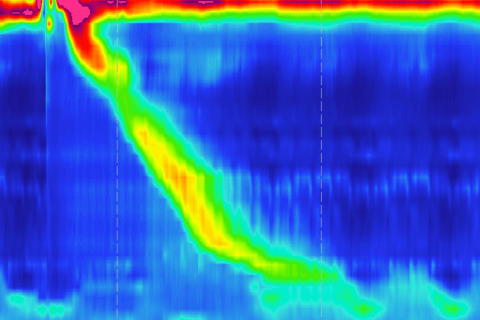 Nagy felbontású nyelőcső manometria